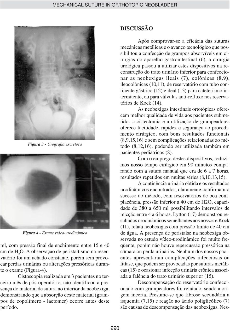 Cistoscopia realizada em 3 pacientes no terceiro mês de pós-operatório, não identificou a presença do material de sutura no interior da neobexiga, demonstrando que a absorção deste material (grampos