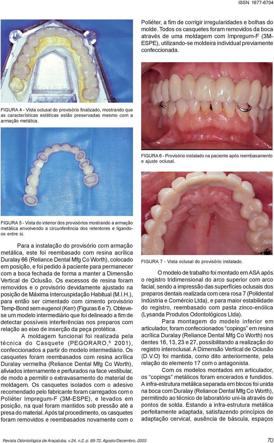 FIGURA 4 - Vista oclusal do provisório finalizado, mostrando que as características estéticas estão preservadas mesmo com a armação metálica.