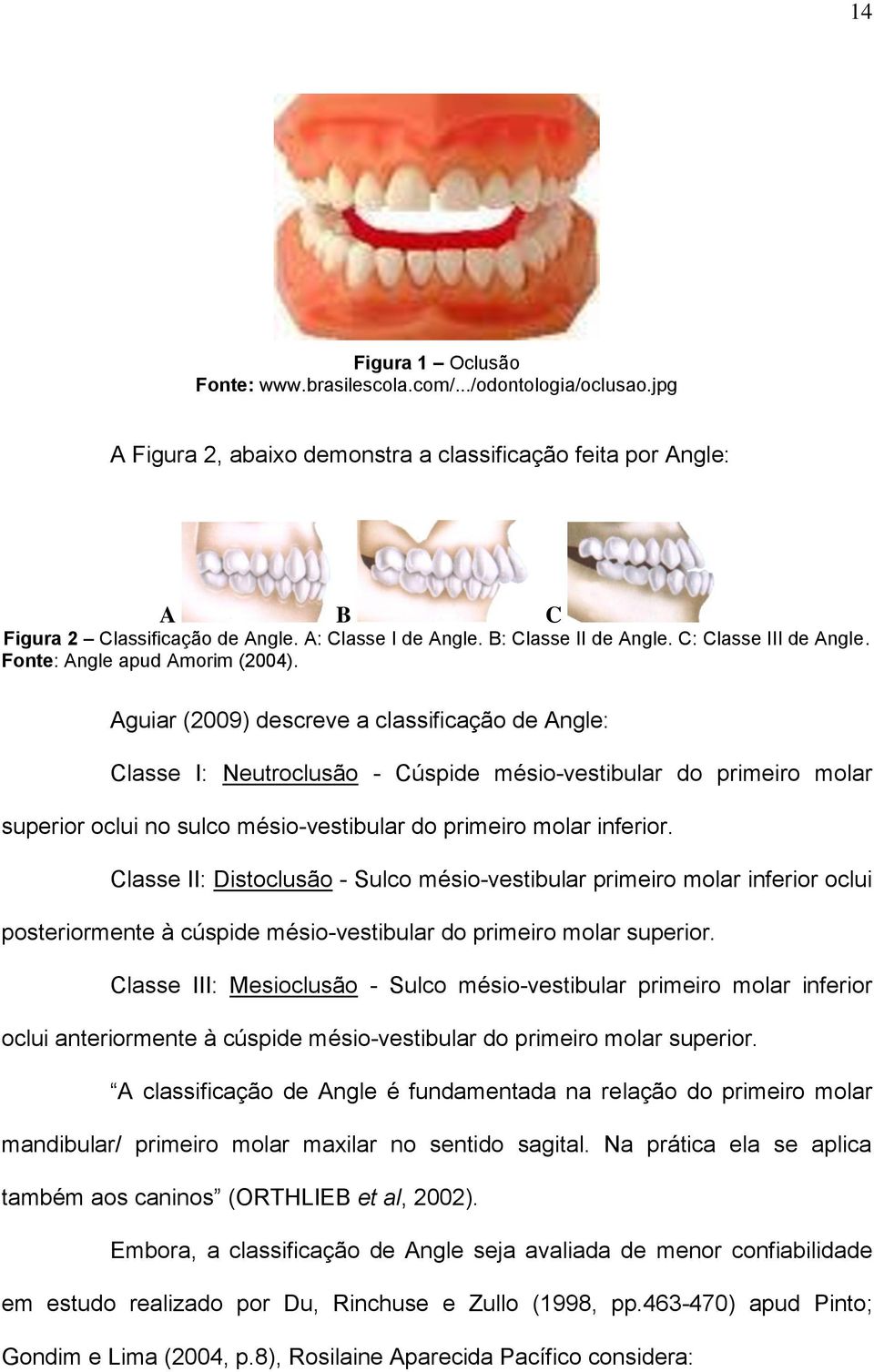 Aguiar (2009) descreve a classificação de Angle: Classe I: Neutroclusão - Cúspide mésio-vestibular do primeiro molar superior oclui no sulco mésio-vestibular do primeiro molar inferior.