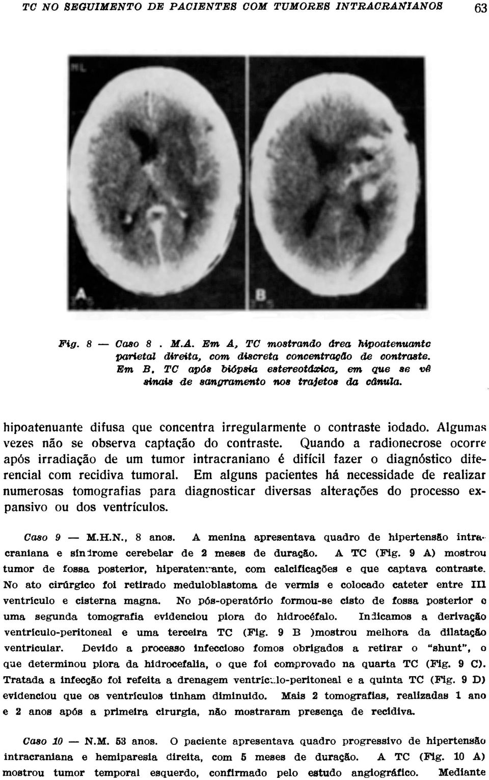 Algumas vezes não se observa captação do contraste. Quando a radionecrose ocorre após irradiação de um tumor intracraniano é difícil fazer o diagnóstico diferencial com recidiva tumoral.