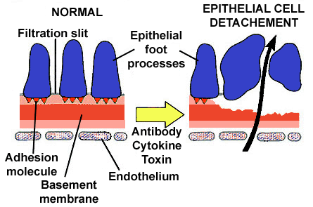 Fisiopatologia Patologia glomerular Alteração da integridade da membrana basal glomerular por processo inflamatório ou imunológico Quimicos