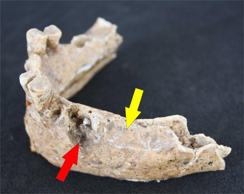 Figura 1. Indivíduo proveniente da sepultura 33, sexo masculino. Em certos casos, os indivíduos possuíam mais de um caso de lesão dentária.