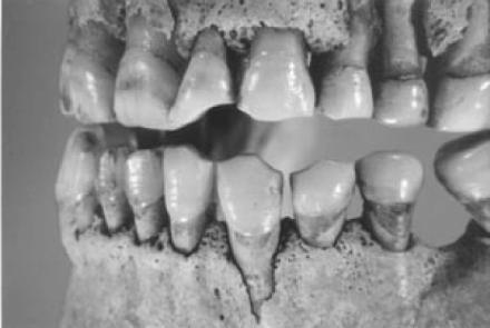 do esmalte e da dentina (ROBB et al, 1991). Consiste na dissolução química dos dentes por ácidos diferentes dos produzidos pelas bactérias orais.