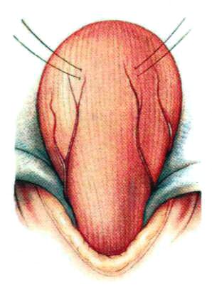 PREPARO E ANESTESIA DO PACIENTE: 1. Depilação 2. Anestesia / medicações 3. Posicionamento decúbito dorsal 4. Antissepsia 5. Colocação dos panos de campo 1.