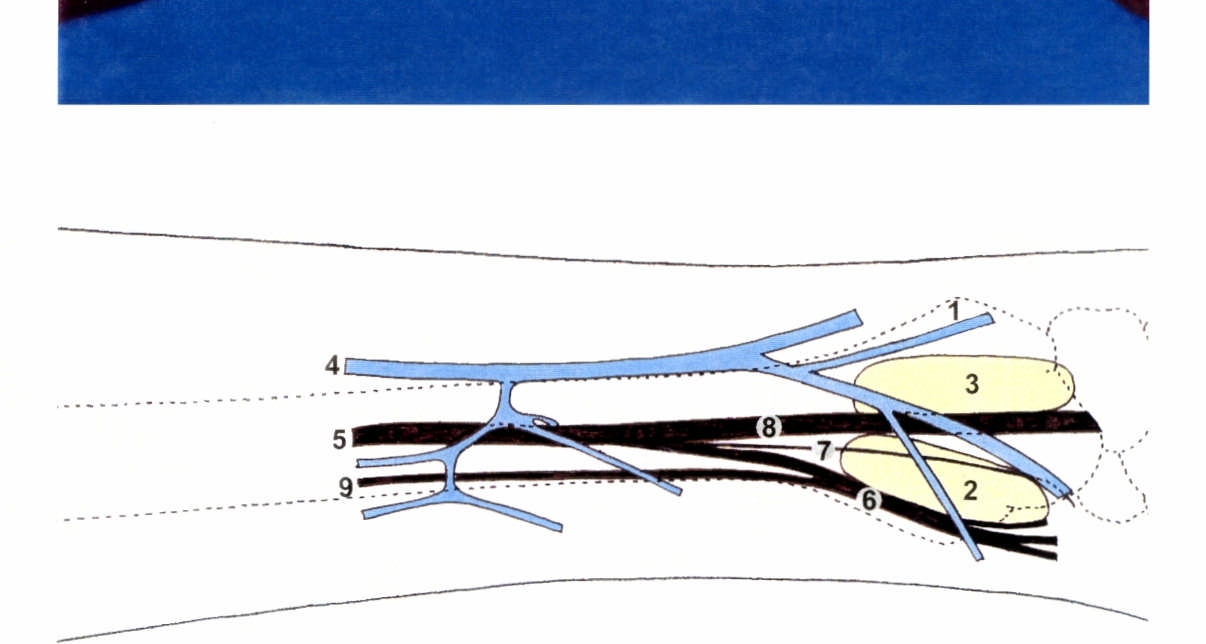 FIGURA 8 - Vista lateral do antebraço esquerdo: 1. tubérculo dorsal do rádio; 2. conjunto de tendões dos músculos abdutor longo e extensor curto do polegar;3.