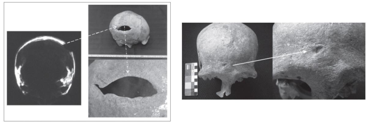 46 históricos. Foram identificados 77 esqueletos, dois deles apresentavam marcas de traumatismo resultante de atividades violentas.