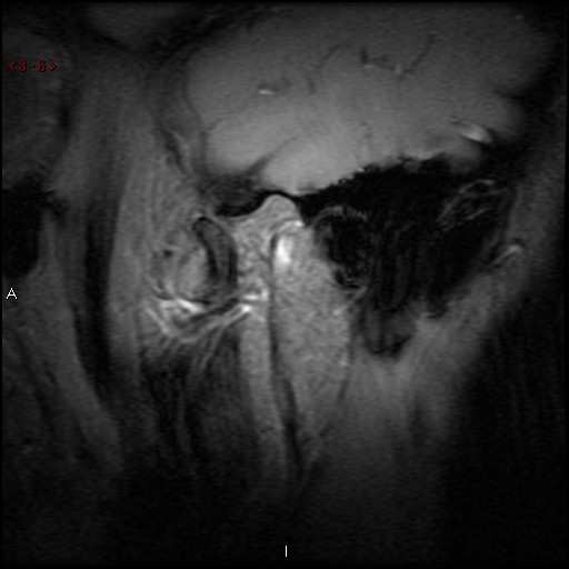 Arqu bras odontol 2010;6(2):71-77 ISSN 2178-0595 68 eminência articular disco articular côndilo zona bilaminar m. pterigóideo lateral Figura 2.