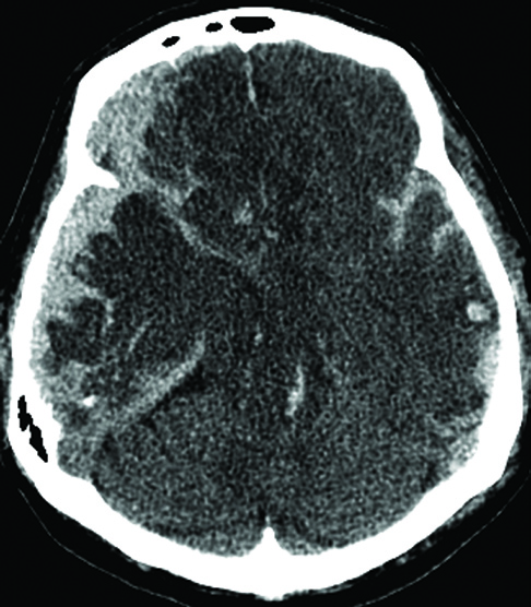 Gattás GS. Imagem no traumatismo craniano. cíngulo insinuando-se por baixo da margem inferior da foice cerebral, ultrapassando a linha mediana.