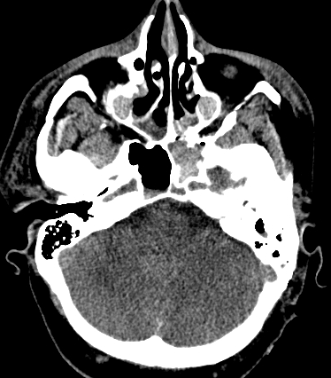 Gattás GS. Imagem no traumatismo craniano.