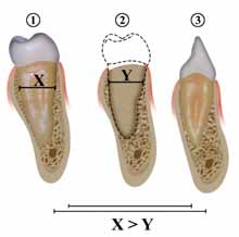 64 Ortodontia - Cabrera & Cabrera Já em relação às verticalmente uma distância favorável entre os ápices radiculares e os seios maxilares, a proximidade vestibulolingual entre as raízes de todos os