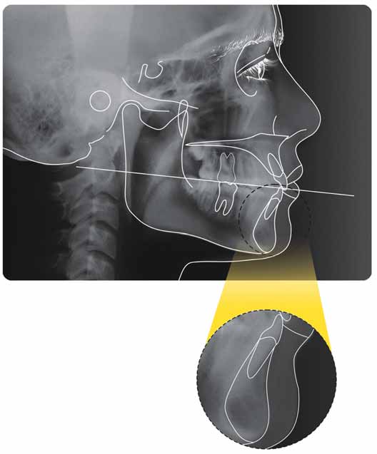 54 Ortodontia - Cabrera & Cabrera 2.5) proporciona visão em cortes coronais ao longo de todo corpo mandibular.