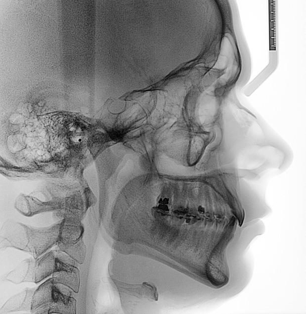 De perfil, ele apresentava leve tendência dolicocefálica, ortognatismo maxilomandibular e um ângulo nasolabial dentro dos padrões de normalidade.