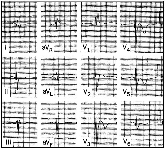 16 QUESTÃO 37 O eletrocardiograma acima é compatível com o diagnóstico de: a) Isquemia subepicárdica. b) Bloqueio de ramo direito. c) Bloqueio de ramo direito mais hemi-bloqueio anterior esquerdo.