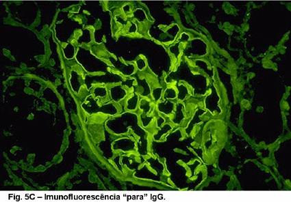 - Qual é o diagnóstico? Glomerulonefrite membranoproliferativa + Glomerulonefrite crescêntica - Em que doenças pode observar este tipo de glomerulonefrite?