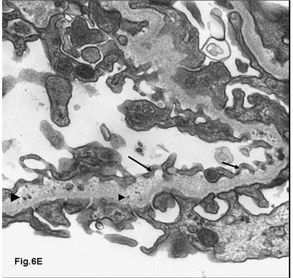 Eritrócitos ficam dismórficos na travessia pela membrana basal aquando da filtração. - Quais os 3 grandes grupos de diagnóstico diferencial na hematúria de origem glomerular?