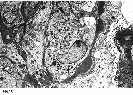 Nas figuras 1A, 1B: Hipercelularidade (infiltrado inflamatório polimorfonucleares; proliferação de células endoteliais e mesangiais). Obliteração de ansas capilares.