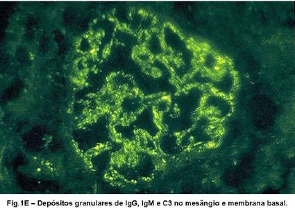 - Como designa a síndrome apresentada por este doente? Síndrome nefrítico agudo. - Qual é o diagnóstico? Glomerulonefrite proliferativa aguda difusa pós-estreptocócica.