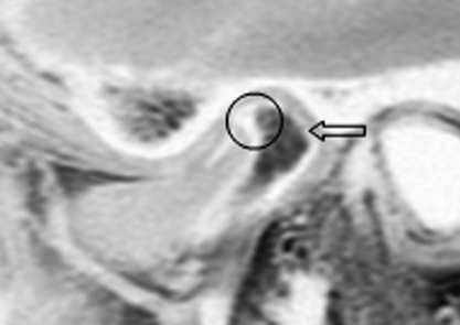 no DDSR, a banda posterior do disco deve estar anterior à porção superior da cabeça da mandíbula tanto na posição de boca fechada como na de abertura máxima (Fig. 2a e 2b).