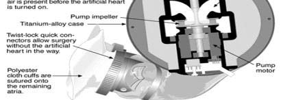 Controlador implantável 7 Abiocor Membrana flexível Coração direito