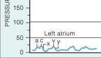 Curva de AE Similar à de AD, embora levemente mais alta Difere de AD: onda v geralmente maior que onda a Amplitude da onda v reflete complacência de AE Em geral não é