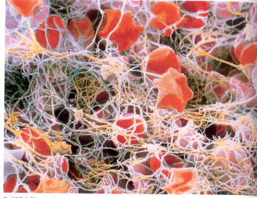 ANEMIA ì Distúrbio sanguíneo mais comum: suprimento inadequado de hemoglobina causa fraqueza, palidez e, às vezes, falta de ar.