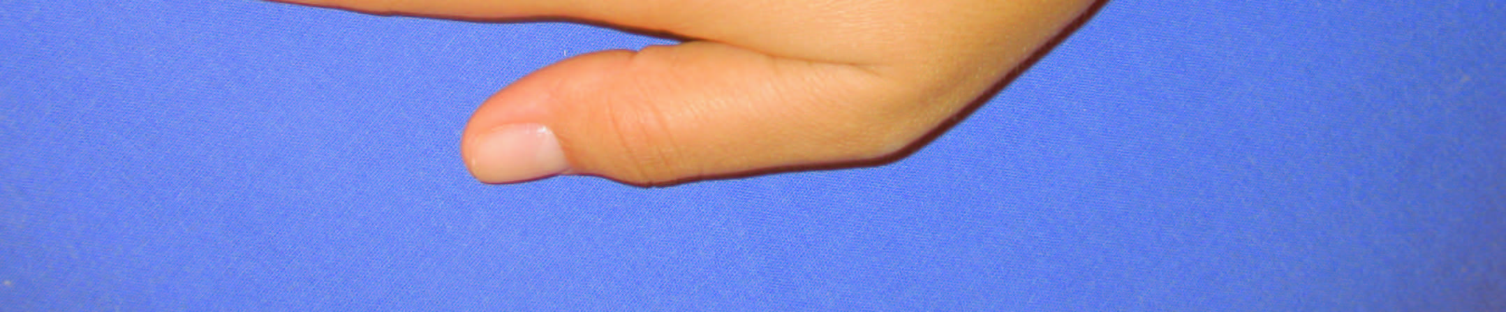 52 3. Comprimento do Dorso da Mão: É a distância em linha reta que vai do meio da linha que uni o stylion radii e o stylion ulneae, ao phalangion do dedo médio (Figuras 21 e 22); Figura