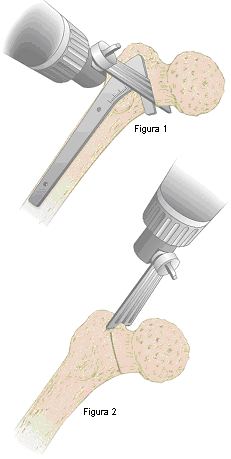 Página 10 1. Osteotomia Femoral O nível de ressecção do colo deve ser baseado no gabarito pré-operatório. Coloque o gabarito sobre o raio-x do quadril.