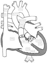 Fig. 3 Ecocardiograma transtorácico, plano paraesternal eixo longo, revelando anatomia do tracto de saída do ventrículo esquerdo (VE). AE: aurícula esquerda Fig.