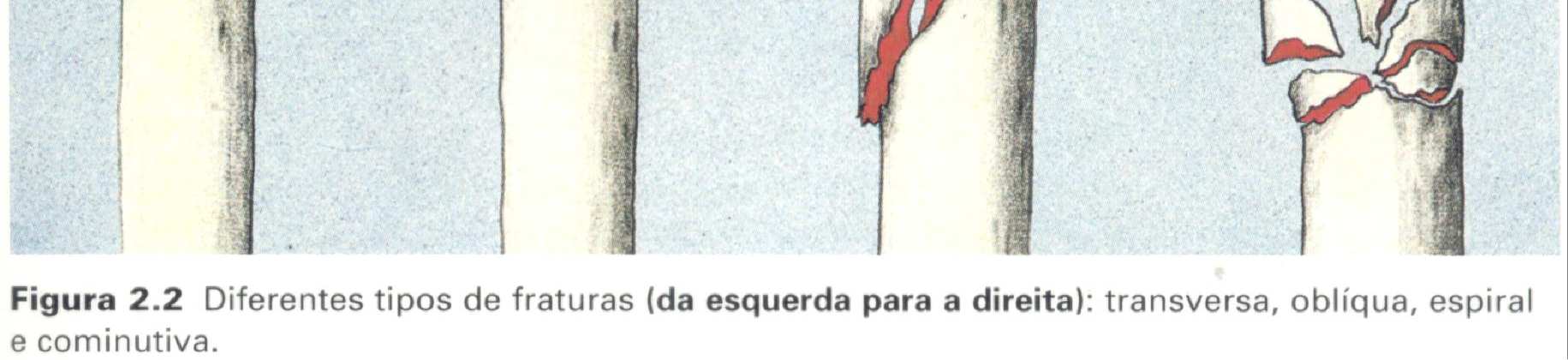 Lesões Ósseas LESÕES ÓSSEAS Anatomia Funcional Sustentação de peso coluna, pelve e MMII; Fixação de músculos, tendões e ligamentos; Proteção de partes moles; Regeneração - fraturas Calo ósseo