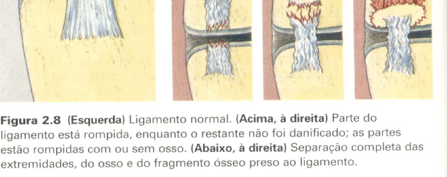 LESÕES LIGAMENTARES Ligamento prende-se aos dois ossos que compõem a articulação; Função Estabilização articular Movimentação Resistir forças de tensão Resistir forças compressivas Lesão excesso de