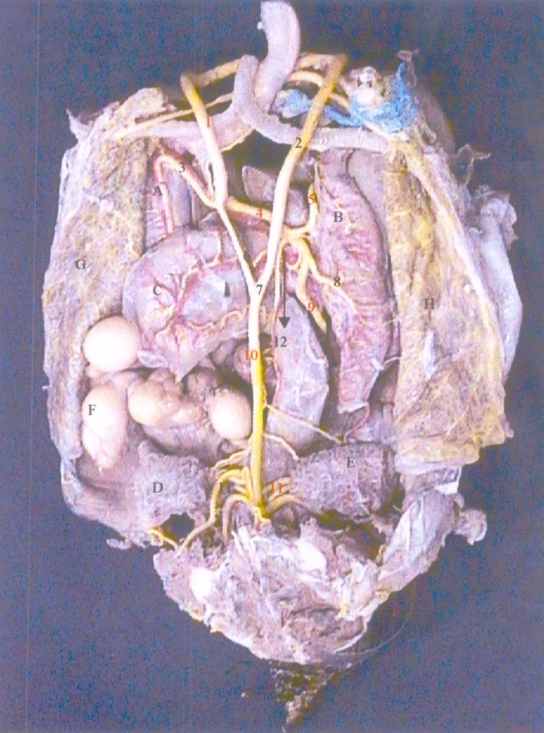 Figura 1 Foto digitalizada de dissecação de Geochelone carbonaria - vista dorsal - Fêmea - Destacando os órgãos e artérias: 1) aorta equerda; 2) aorta direita; 3) artéria gástrica; A) estômago; 4)
