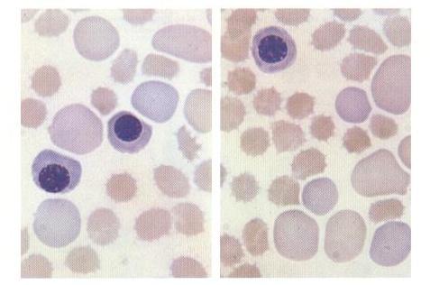 Alterações de Hemoglobinização (Concentração de Hb) 4.