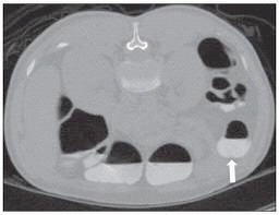 A aquisição de imagens em dois decúbitos ventral e dorsal) é necessária para melhorar a diferenciação entre resíduos alimentares e pólipos verdadeiros