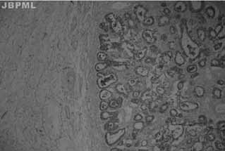 secretor ciliado tipo tubário, com formação de papilas sem atipias (Figura 3) e cápsula ovariana preservada.