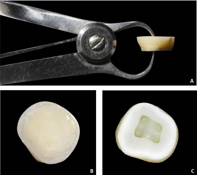 47 Foram feitas duas secções horizontais: a primeira paralela à superfície oclusal, para a exposição da dentina e a segunda 1 mm abaixo da junção amelocementária, para a separação da coroa da porção