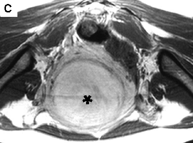 Fig. 10 - Leiomioma intramural anterior, com 9 cm de diâmetro e degenerescência mixóide periférica, em mulher de 46 anos.