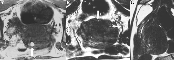 Fig. 15 - Adenomiose difusa (A). Corte sagital T2 com área hipointensa em banda na camada interior do miométrio em relação com aumento da espessura zona juncional (> 12mm) (seta).