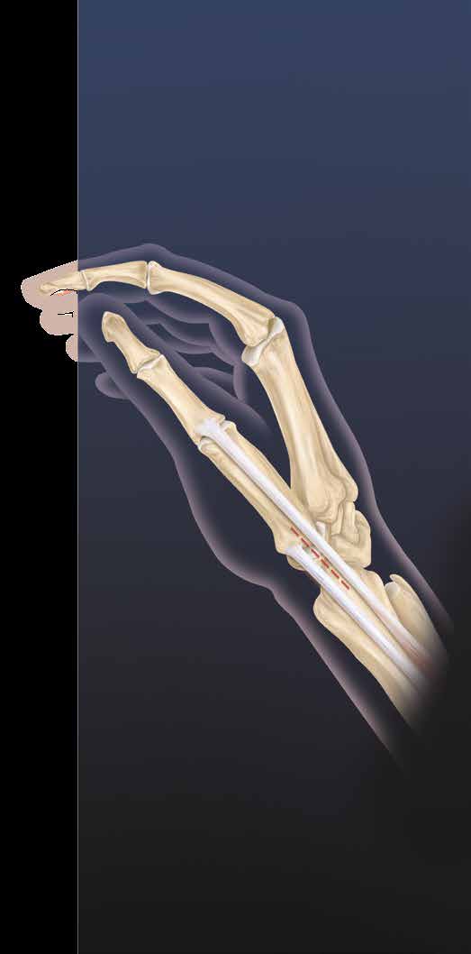 Reconstrução ligamentar e interposição de tendão para artrite da articulação CMC do polegar Artrite da base do polegar é uma doença debilitante, normalmente acompanhada de subluxação do metacarpo e