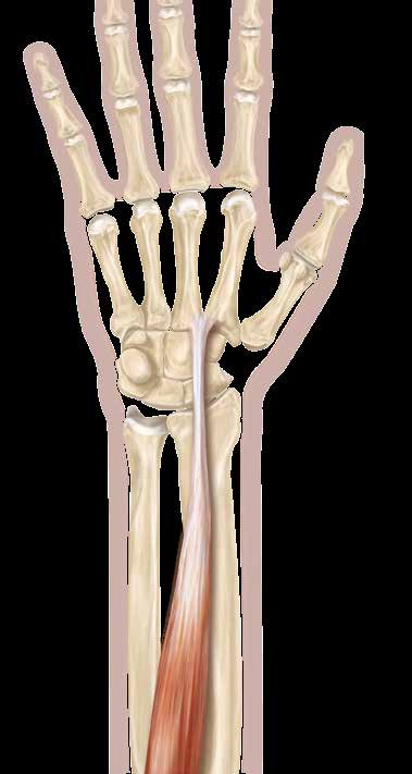 1 2 Aspecto dorsal A incisão longitudinal no aspecto dorsorradial do punho é feita apenas pela derme, para evitar lesão do ramo sensitivo do nervo radial.