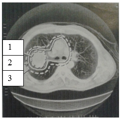 41 Um profissional das técnicas radiográficas começa a trabalhar no setor de radioterapia de uma clínica. Logo ele se depara com uma imagem contendo as siglas GTV, CTV e PTV.