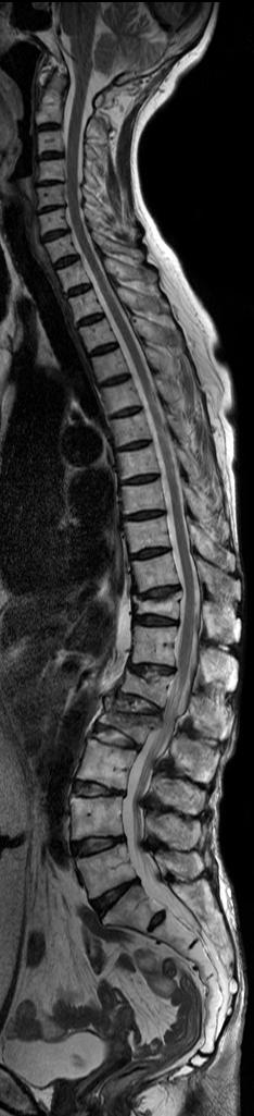 RESSONÂNCIA MAGNÉTICA Total Spine Imaging T1W TSE 0.9 x 0.