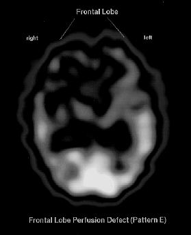 Padrão E Experiência Preliminar Demência CT SPECT N (+) (-) (+) (-) DAT 34 18 16 16 18 Outras 29 09 20