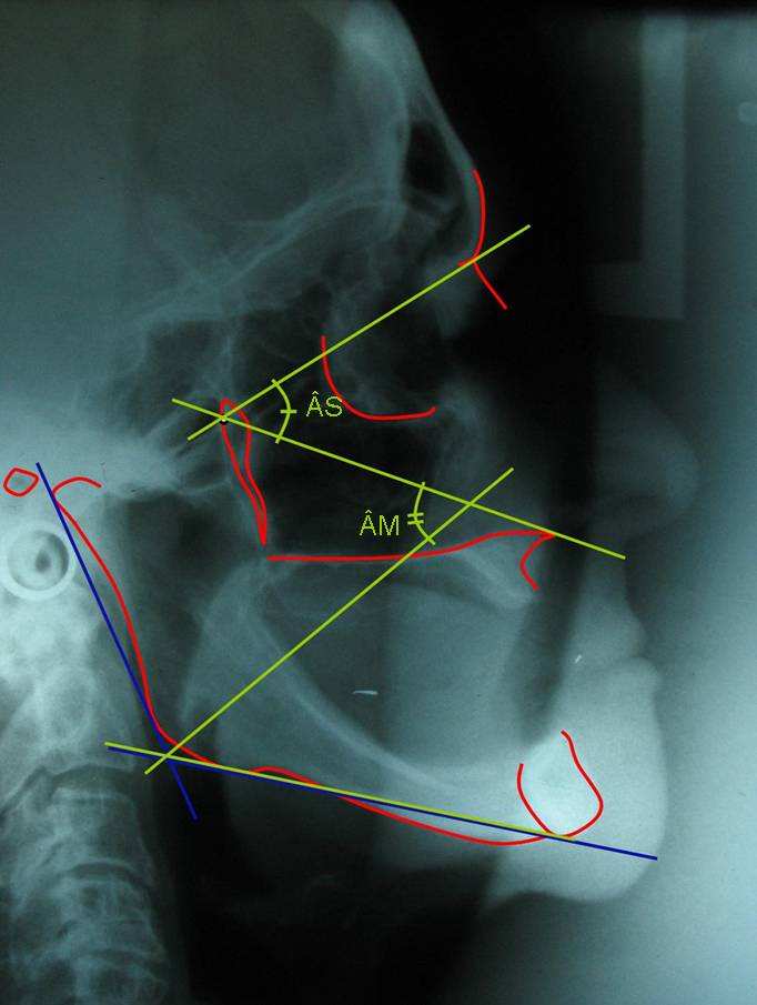 38 Figura 9 Análise cefalométrica sobre a Telerradiografia Verificar ausência de paralelismo entre a reta CF-ENA (Verde) e Plano Mandibular (Azul) Figura 10 Análise cefalométrica sobre a