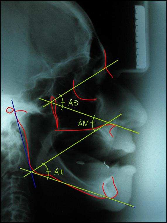 40 Figura 17 Nova Telerradiografia. Análise cefalométrica.