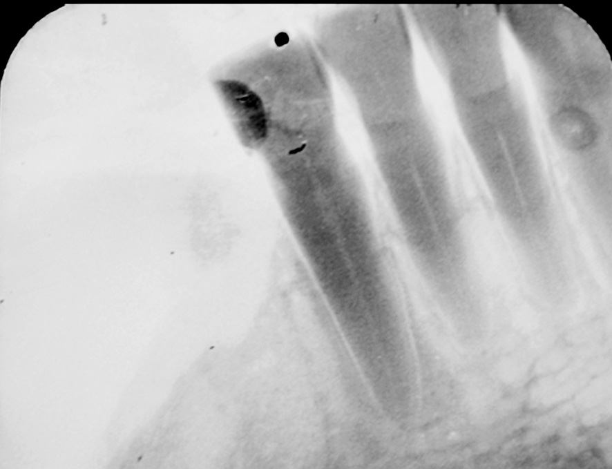 Fibroma ossificante periférico: um levantamento clínico e epidemiológico Gráfico 1.