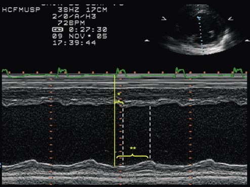 Avaliação de sincronia intraventricular: Modo M: O modo M também tem sido descrito como uma alternativa para a avaliação de sincronia intraventricular.