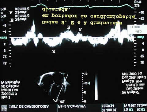 Figura 6 Medidas do tempo de aceleração do fluxo sistólico na via de saída do ventrículo direito, e também da velocidade do refluxo tricúspide quando presente, fornecem valiosas informações sobre a