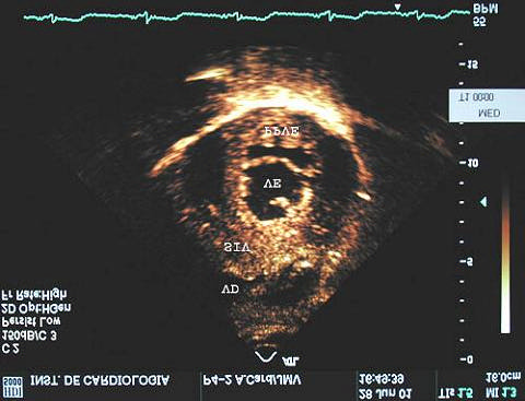 Alterações ecocardiográficas: Destaca-se a hipertrofia exagerada e desproporcional do septo interventricular a qual é bem visualizada através do modo M e do bidimensional (Figs. 9 e 10).