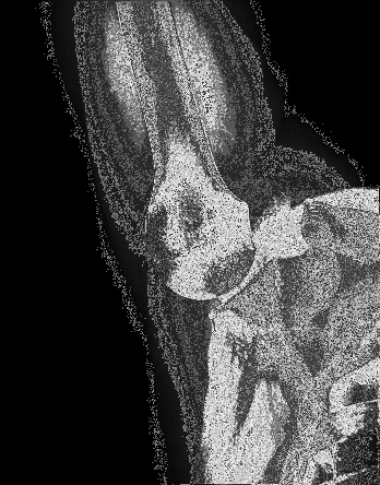 SBOT. Ortopedia do adulto. Síndromes compressivas. 7) Na lesão extensa do manguito rotador, GERBER preconiza transferência do grande dorsal quando há integridade do a) subescapular. b) peitoral maior.
