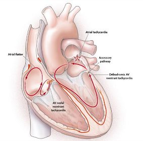 Revista da Faculdade de Ciências Médicas de Sorocaba RITMO SINUSAL TAQUICARDIA POR REENTRADA ORTODRÔMICA TAQUICARDIA POR REENTRADA ANTIDRÔMICA ÁTRIO NAV VAC VENTRÍCULO ELETROCARDIOGRAMA P Figura 3.